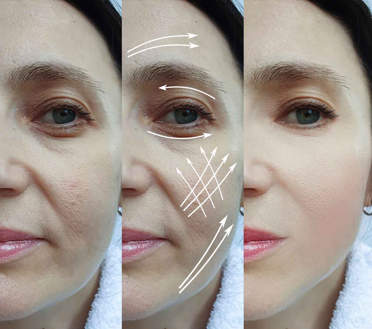 woman face wrinkles before and after treatment arrow